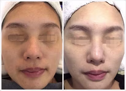 BB Glow Facial Treatment Promotion