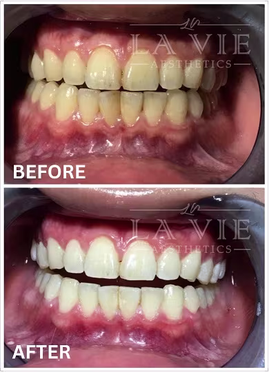 Best Teeth Whitening Treatment Promotion